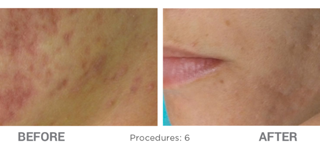 Microneedling-Before-After-3