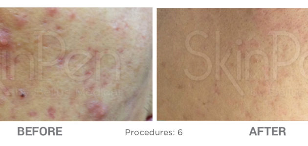 Microneedling-Before-After-4