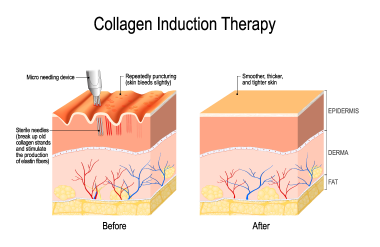 Collagen Induction Therapy